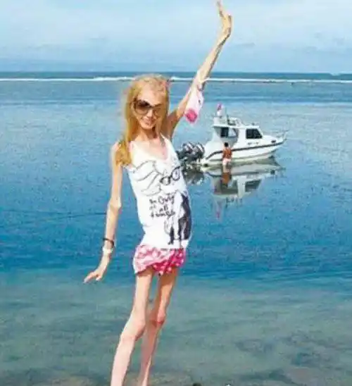 世界上最瘦人的照片 看完简直令人震撼