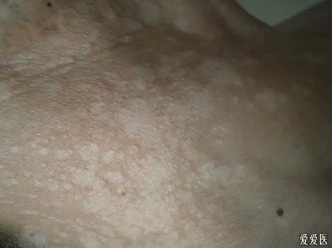 典型病例欣赏:花斑癣. - 皮肤及性传播疾病讨论版 - 爱爱医医学论坛