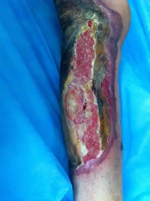 某某,男,76岁,双下肢三度烧伤,既往高血压脑出血后遗症,慢支病史,生活