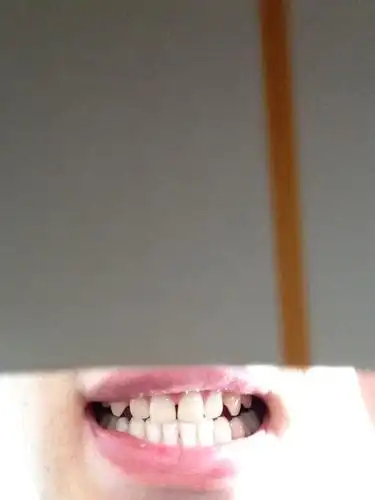 问:门牙中间有缝怎么矫正?