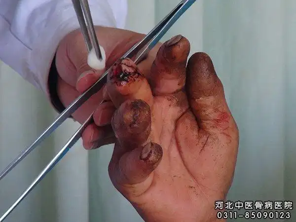 化脓性骨髓炎的病因与诊断