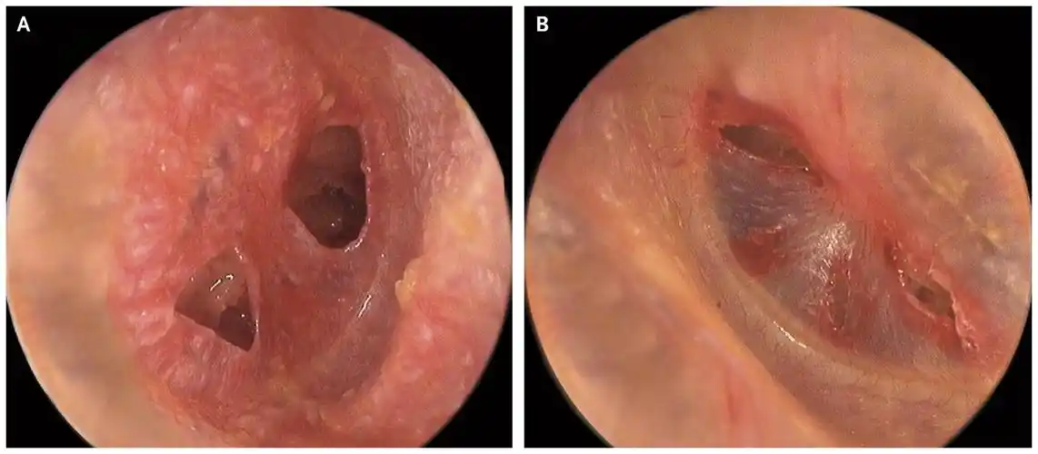 binaural tympanic-membrane perforations after blast injury