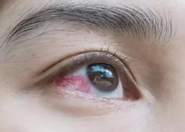 眼睛不是,干眼症症状表现有哪些?干眼症最简单的自愈方法是什么?