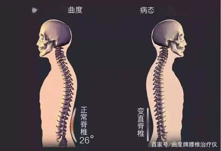 导致腰椎生理曲度变直的原因,你了解多少?