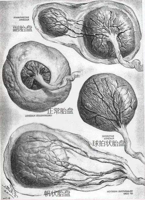 出现帆状胎盘孕妈们该怎么做这篇文章告诉你答案