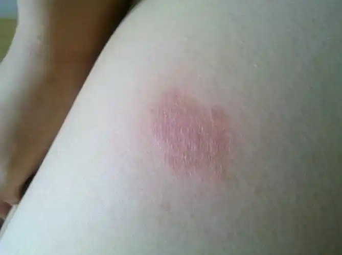 用吗替麦考酚酯分散片来治疗系统性红斑狼 龟头有红斑,不疼不痒 2013