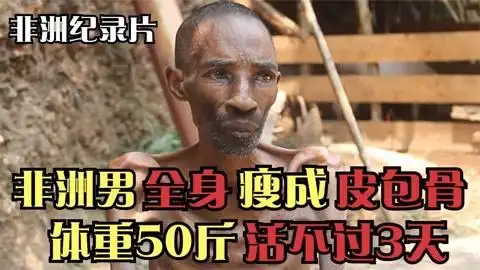 非洲男人全身瘦成皮包骨,体重只有50斤,被断定活不过3天!