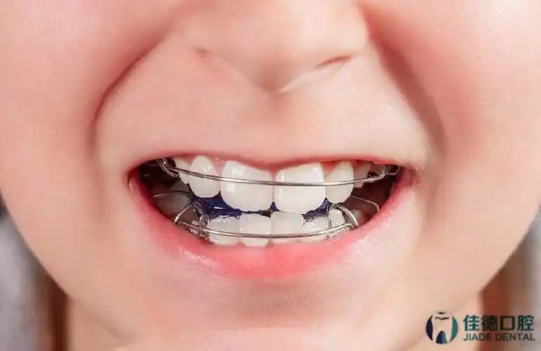 合肥儿童牙齿矫正