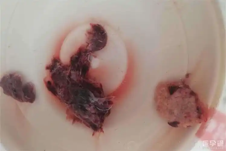 掉下来的完整孕囊图片两大区别可明辨图片血腥慎入