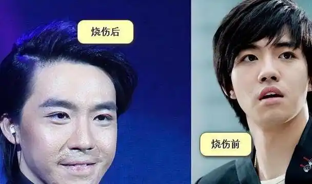 意外"毁容"的明星:胡歌留下终身伤疤,俞灏明内心伤痛难治愈