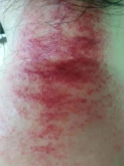 10月3日肩颈刮痧图