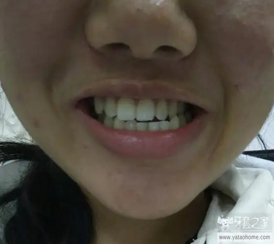 咬合不齐导致脸歪正畸之后能矫正么-牙医咨询-牙套之家|牙齿矫正 中国