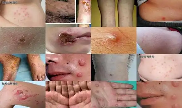 梅毒初期症状图 - 汕头梅毒症状图片