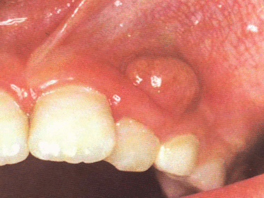周组织的化脓性炎症的一系列反应过程可发展为牙槽骨的局限性骨髓炎