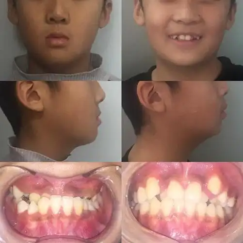 9岁男娃长成"地包天"不敢笑,这病到底该咋治?