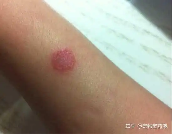 人能得猫癣,狗癣吗?