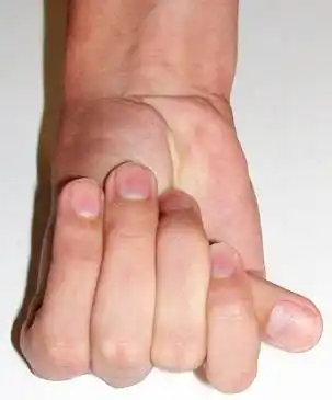 也有人因此称马凡氏综合征病人为蜘蛛人,双臂平伸指距大于身长,双手