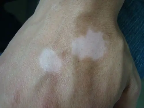 白癜风(局限型) - 皮肤及性传播疾病讨论版 - 爱爱医医学论坛