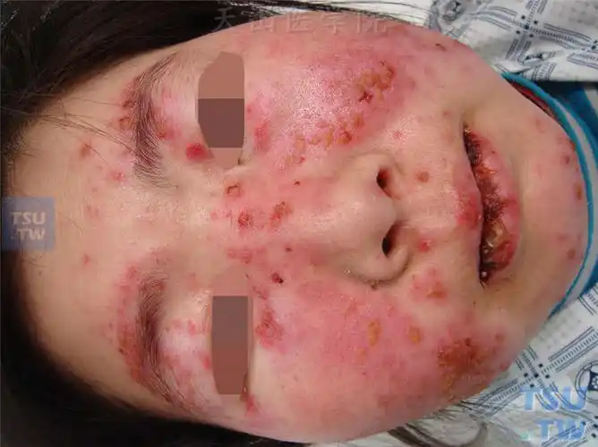 系统性红斑狼疮(sle)的症状表现