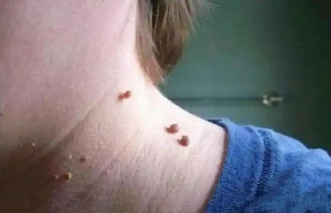 为什么得了丝状疣后医生都会建议我们不要搓澡呢?