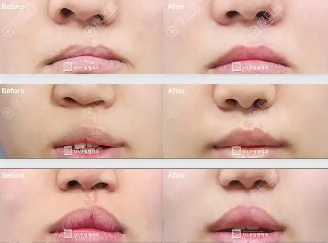 韩国唇腭裂疤痕修复结合激光治疗使术后恢复效果更好