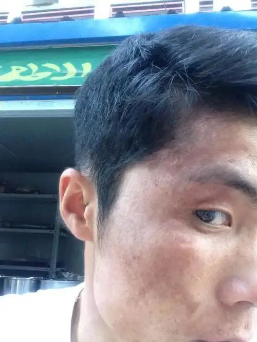 面部黑色素沉淀如何去除 如何去除脸上的黑色素