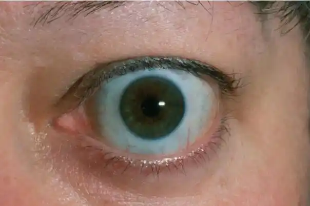 以及眼球突出,眼球运动障碍和复视,角膜病变等,部分患者还有全身症状