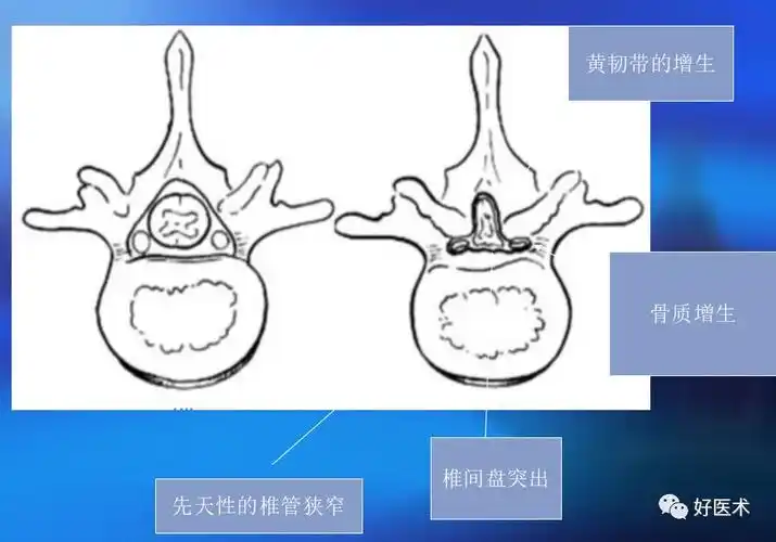 早读手术技巧详解腰椎椎弓根内固定椎间融合术