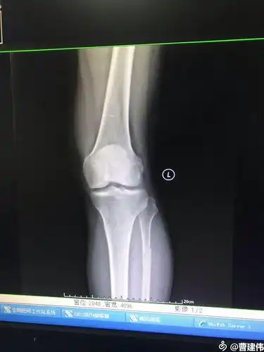 恒扬在左胫骨平台骨折修复术应用