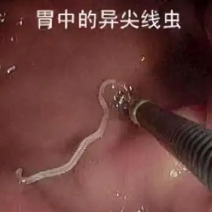 来自海产的寄生虫异尖线虫一旦患上无药可治