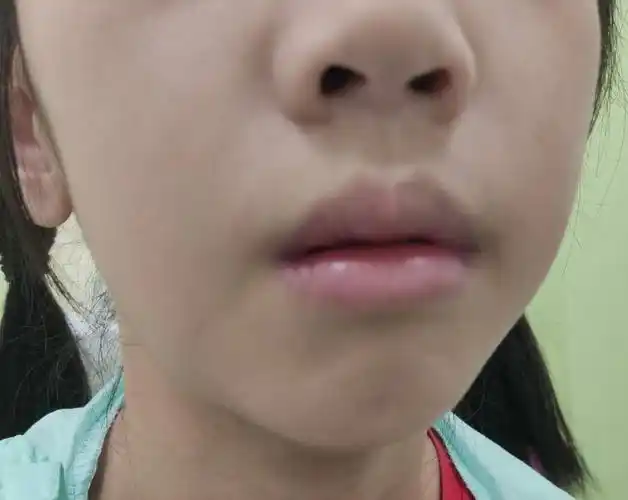 从发现鼻炎腺样体肥大扁桃体肥大这些年孩子到底经历了什么