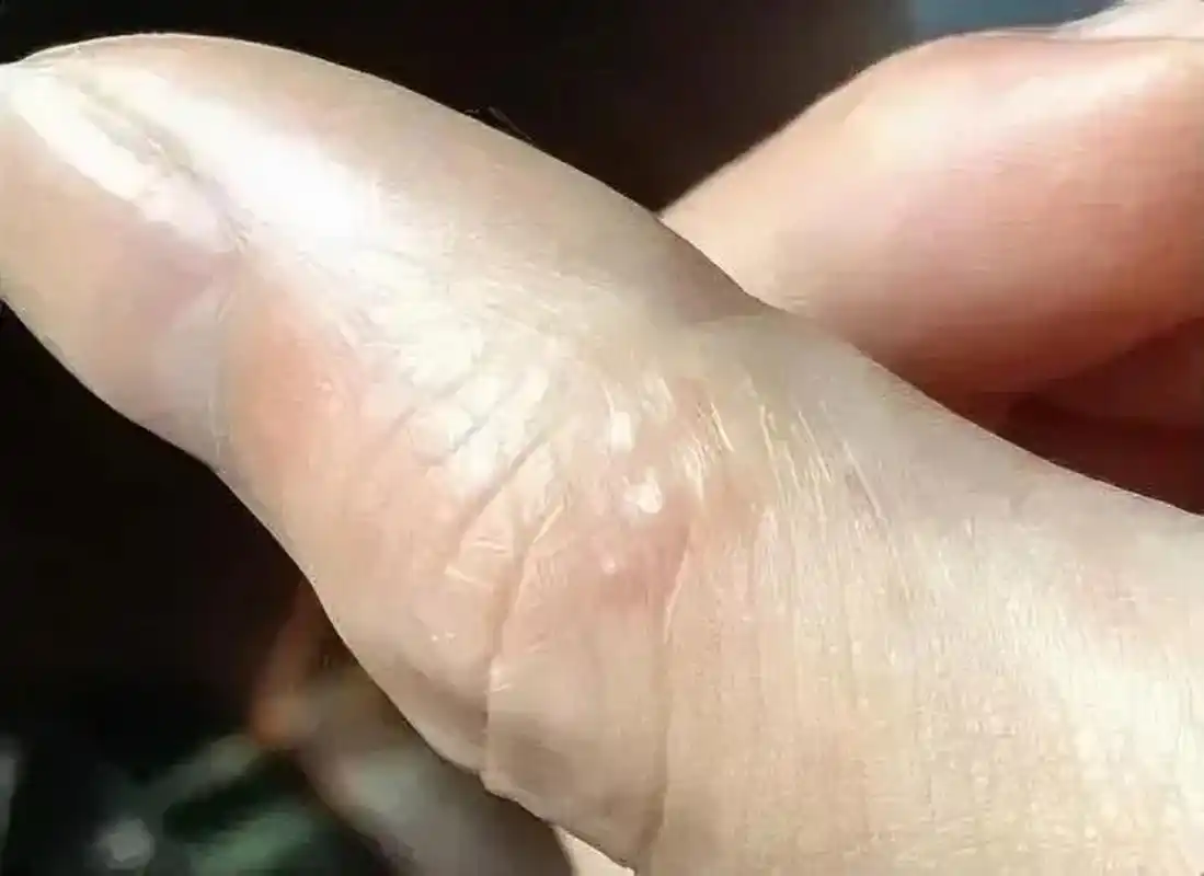 最近女儿和我讲妈妈,我手上老是有皮褪下来,而且有点痒痒的,还有的