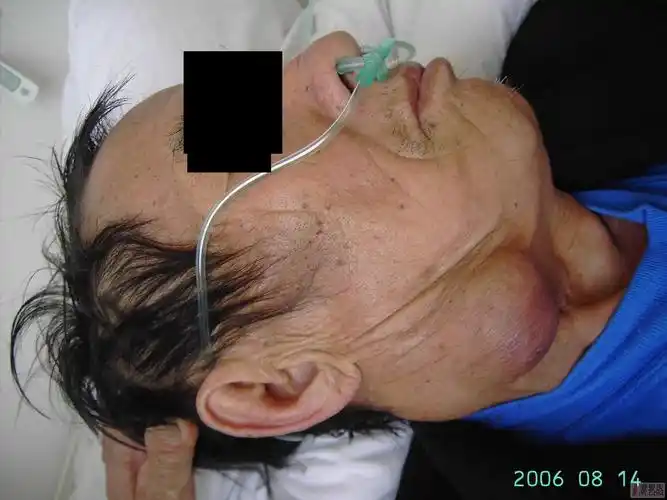 原创颈部恶性肿瘤晚期肺转移