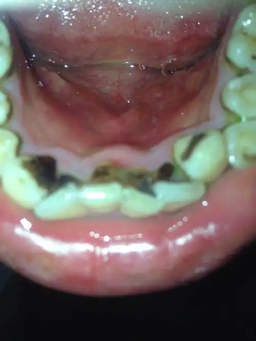 昨天早上突然发现下颚正前方牙龈内壁肿痛,今天肿痛更严重,而且起床