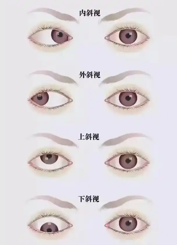 04斜视6015就是我们俗称的"斗鸡眼",指的是眼睛平视正前方时