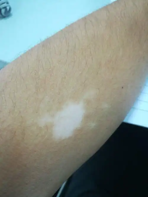 手臂有白斑,而且汗毛是白色的,请问是什么症状