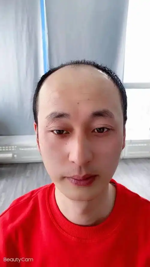 秃顶的男孩怎么办?