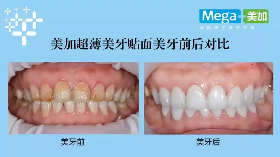 首页 口腔百科 牙齿美白 牙齿美白适应症      美加超薄美牙贴面,薄至