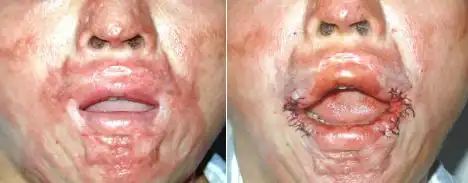 口周挛缩性瘢痕治疗前          术后即时