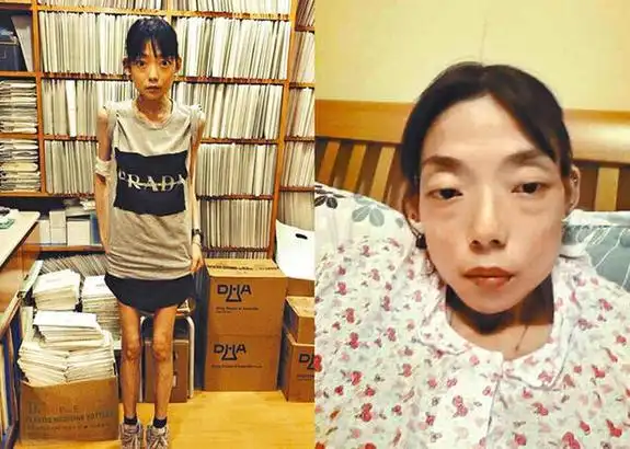 她22岁高调嫁入豪门,却患上厌食症瘦到44斤,丈夫已另结新欢!