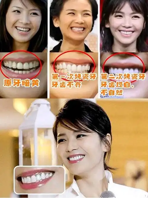 烤瓷牙翻车的明星合集