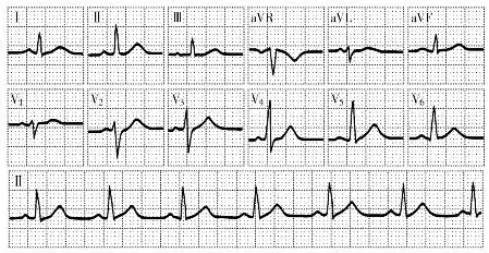 正常心电图波形特点和正常值