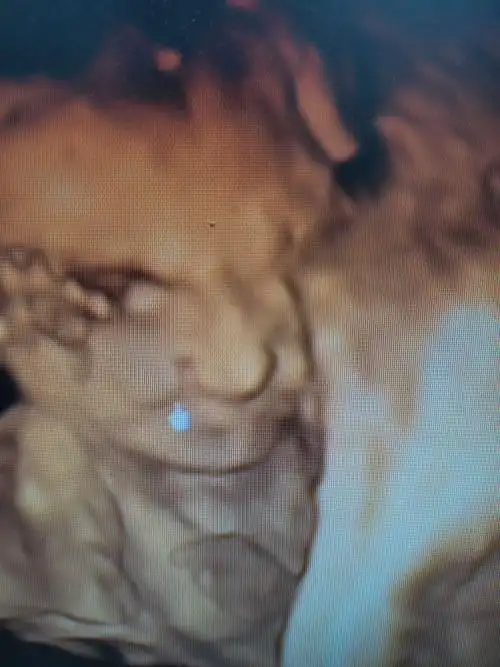 超声诊断胎儿唇腭裂