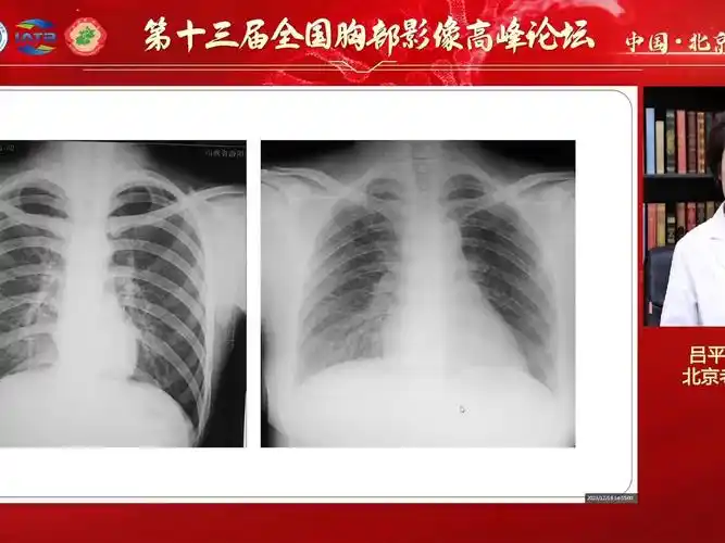 不典型血行播散性肺结核的影像表现--吕平欣