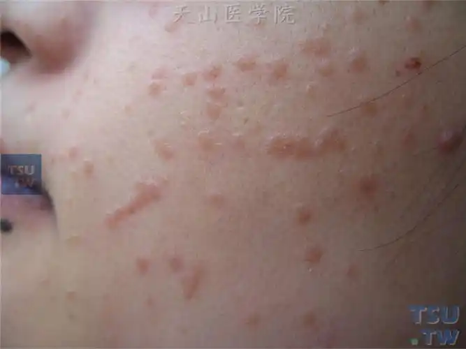 扁平疣verrucaplana症状表现