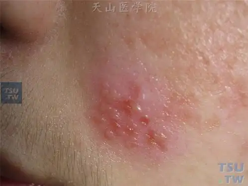单纯疱疹(herpes simplex)症状表现 - 皮肤病学 - 天山医学院