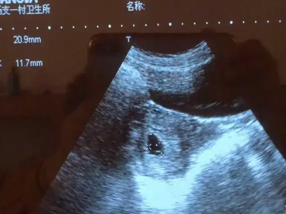 怀孕45天通过孕囊形状看男女是真的吗