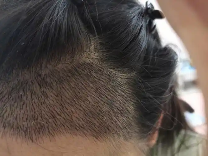 植发际线第12天