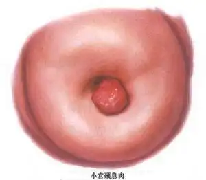 宫颈息肉术后有白带吗