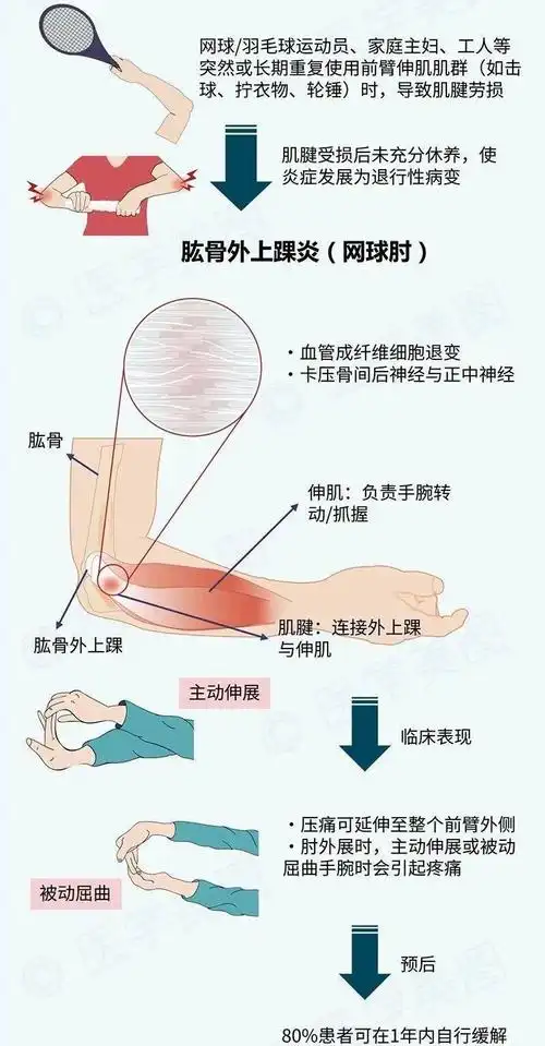不容忽视的肱骨外上髁炎